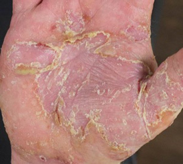 The chinese medicine treatment of hand eczema – Drishti Magazine